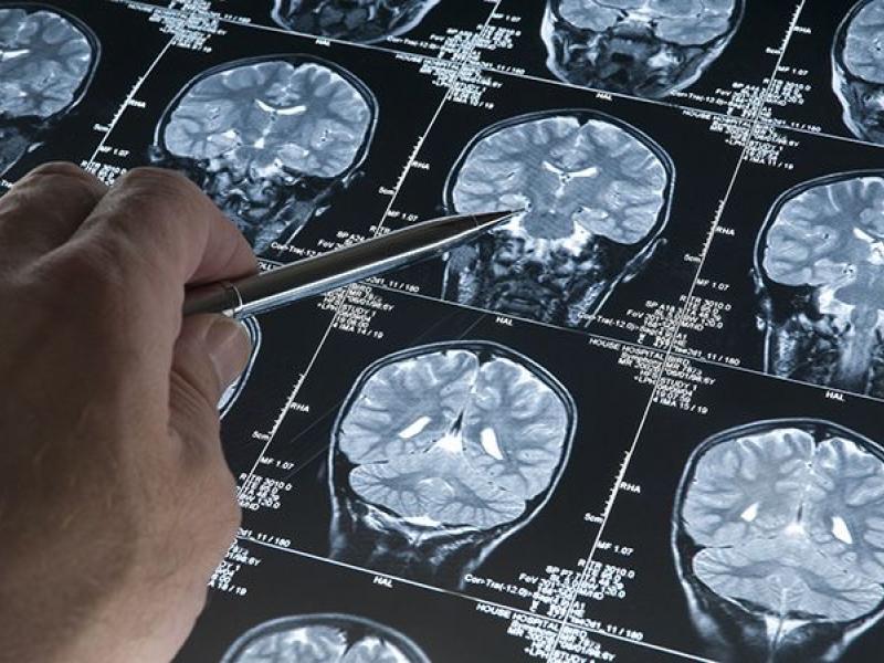 N. Scott Litofsky brain cancer research 